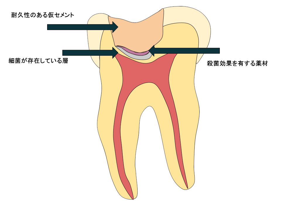 間接覆髄