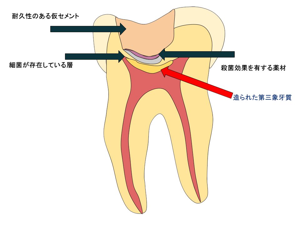 第三象牙質が作られた図