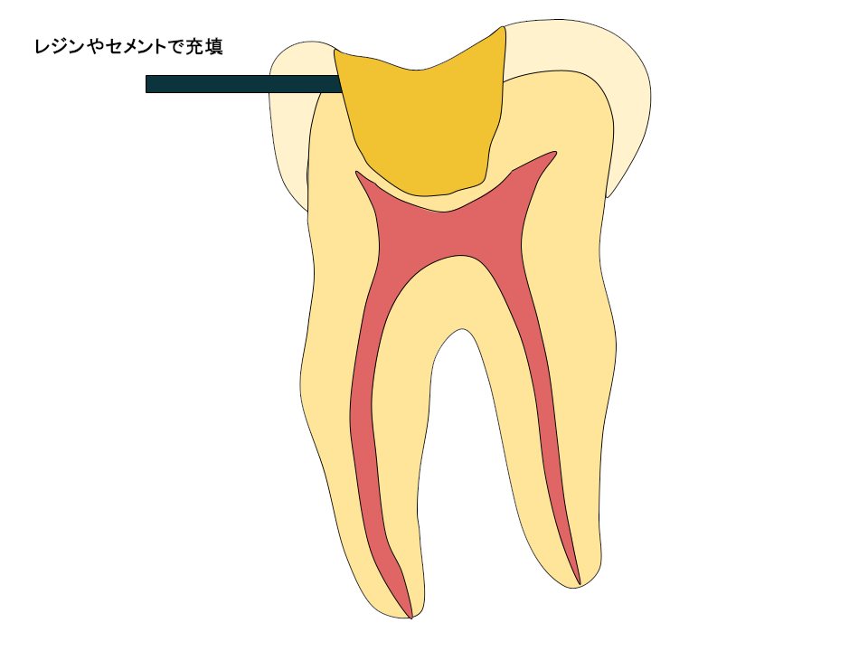 レジンやセメントで充填をしました