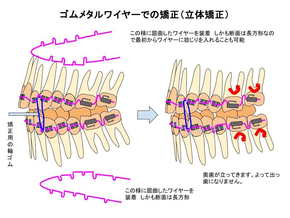 立体レベリング