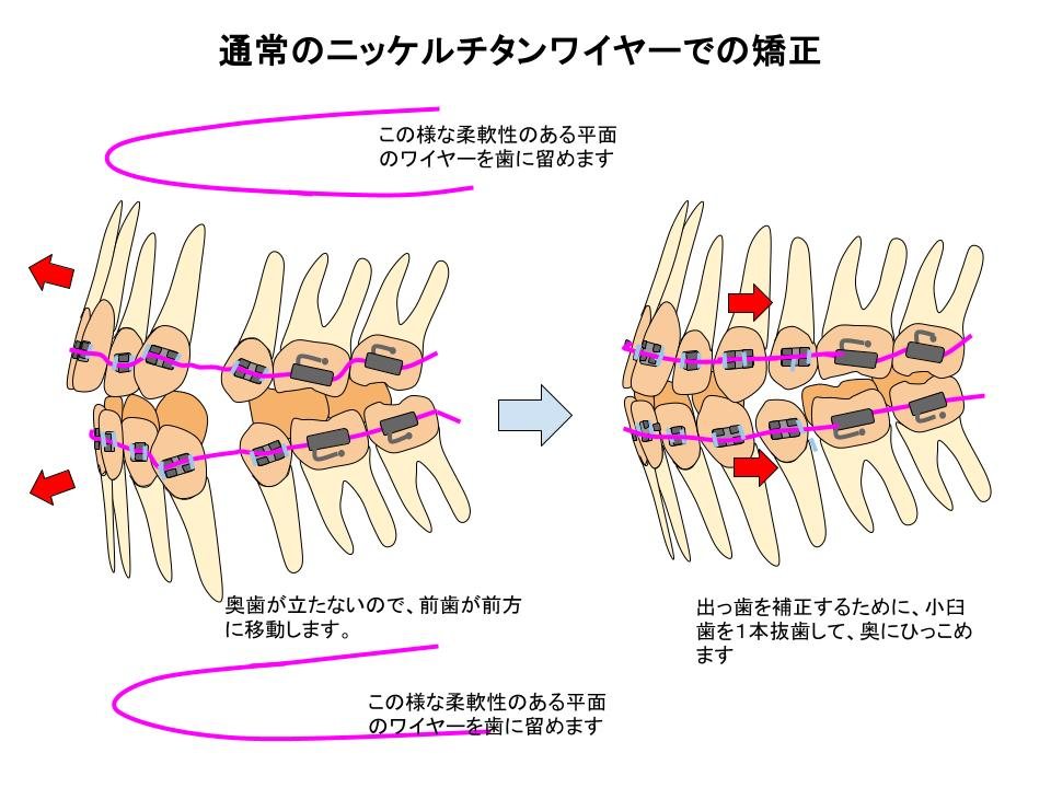 通常のレベリング