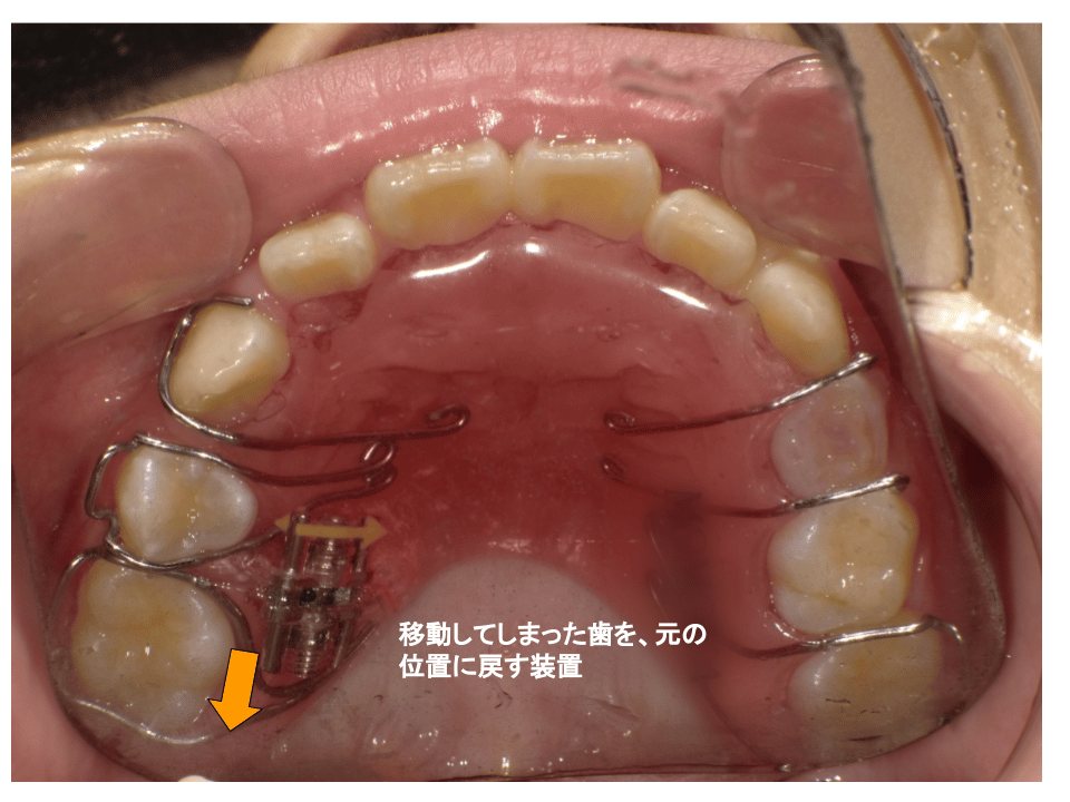床矯正装置