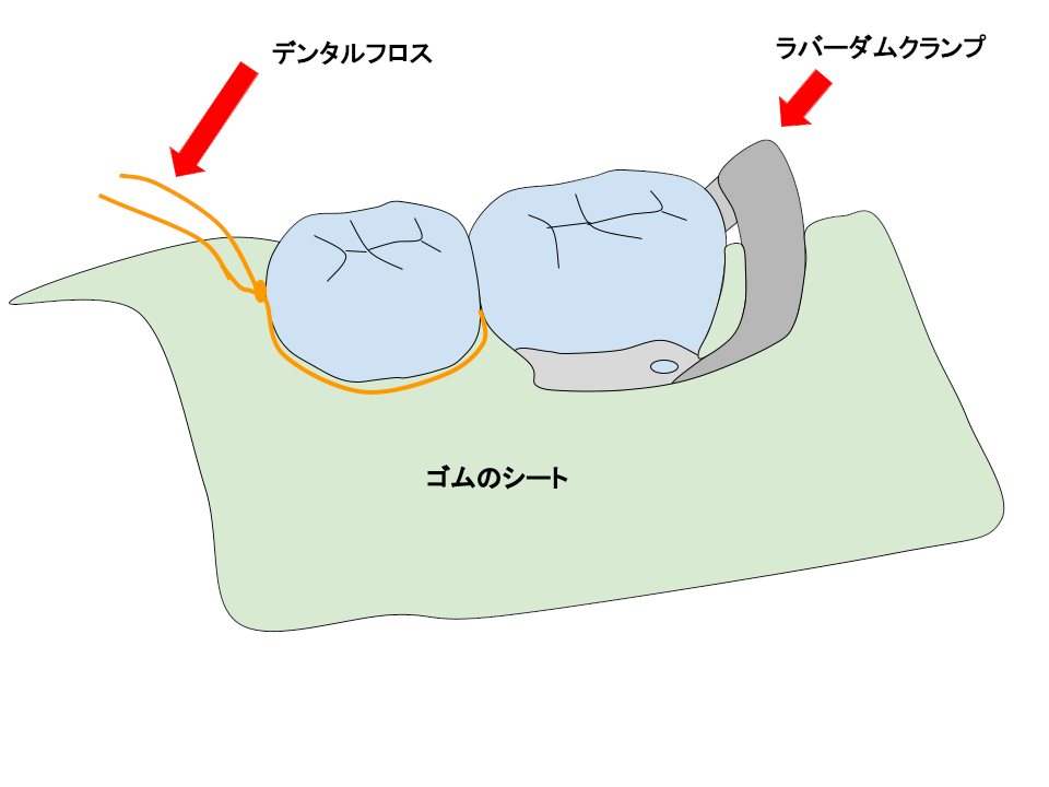 ラバーダム防湿(2歯)