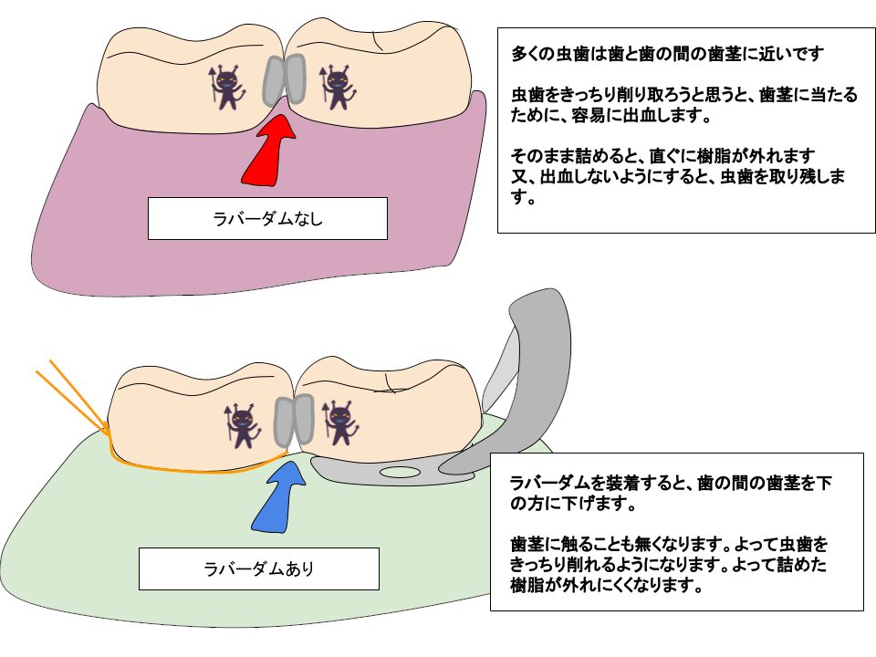 ラバーダムの図