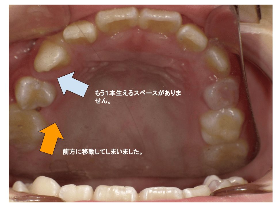 歯の前方への移動