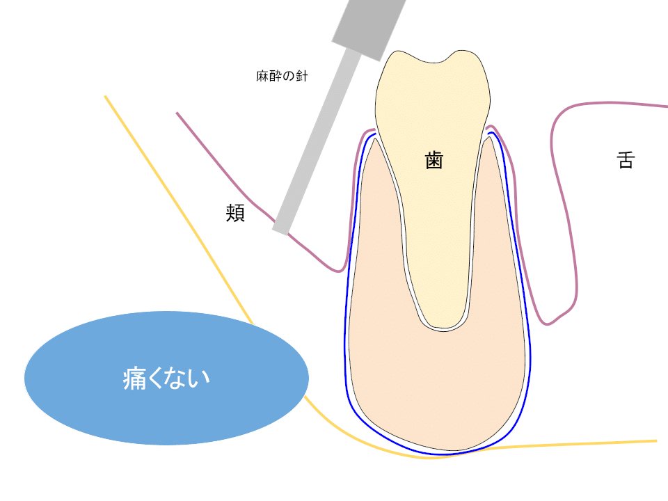 痛くない麻酔