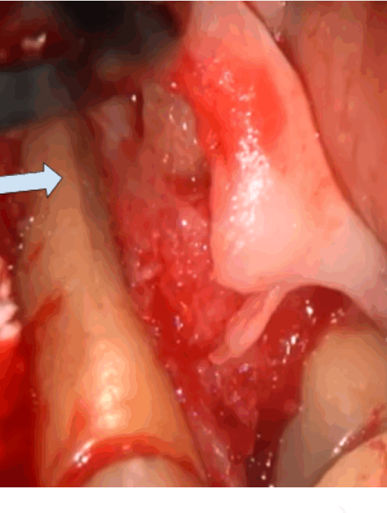 歯肉は剥離して確認。歯根破折を起こした歯（根の先の方でヒビを確認できます）