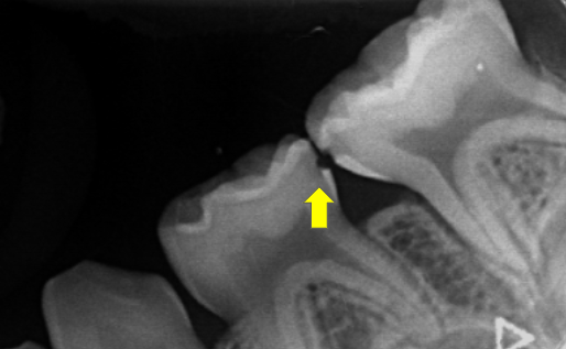 歯の間の虫歯のレントゲン（乳歯）