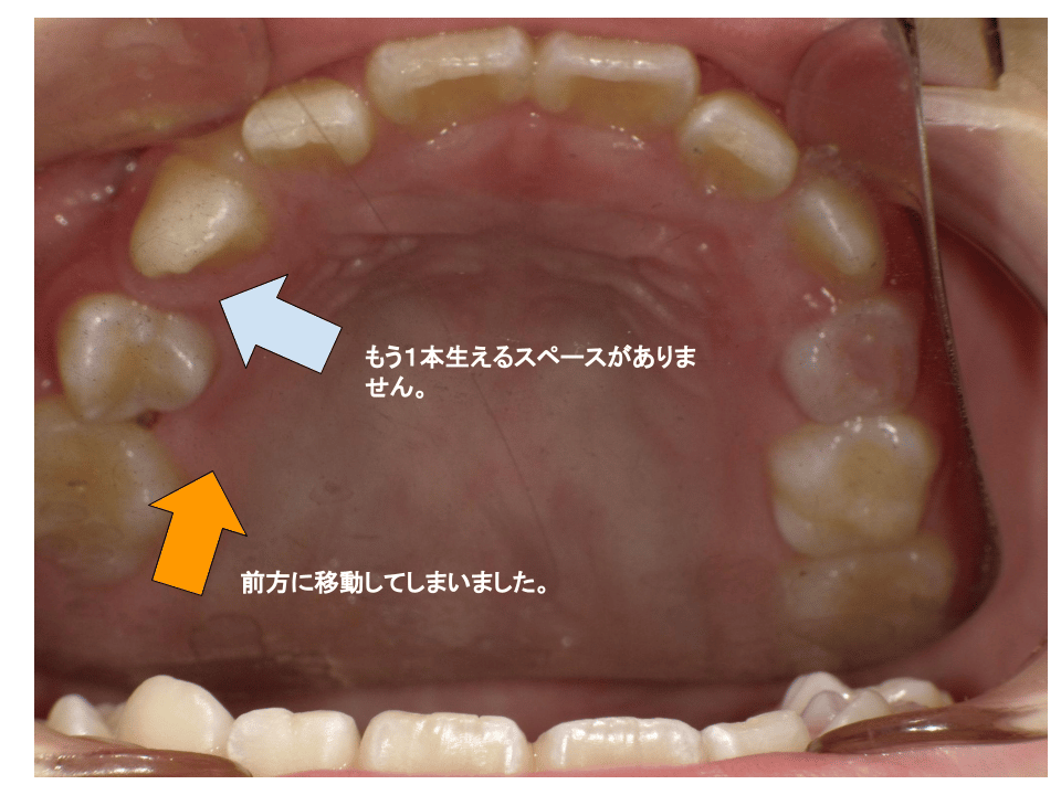 歯の前方への移動
