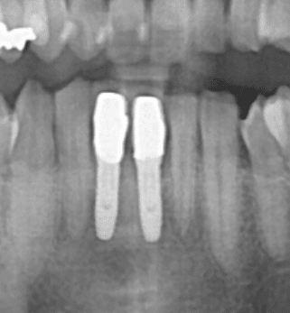 下顎前歯インプラント