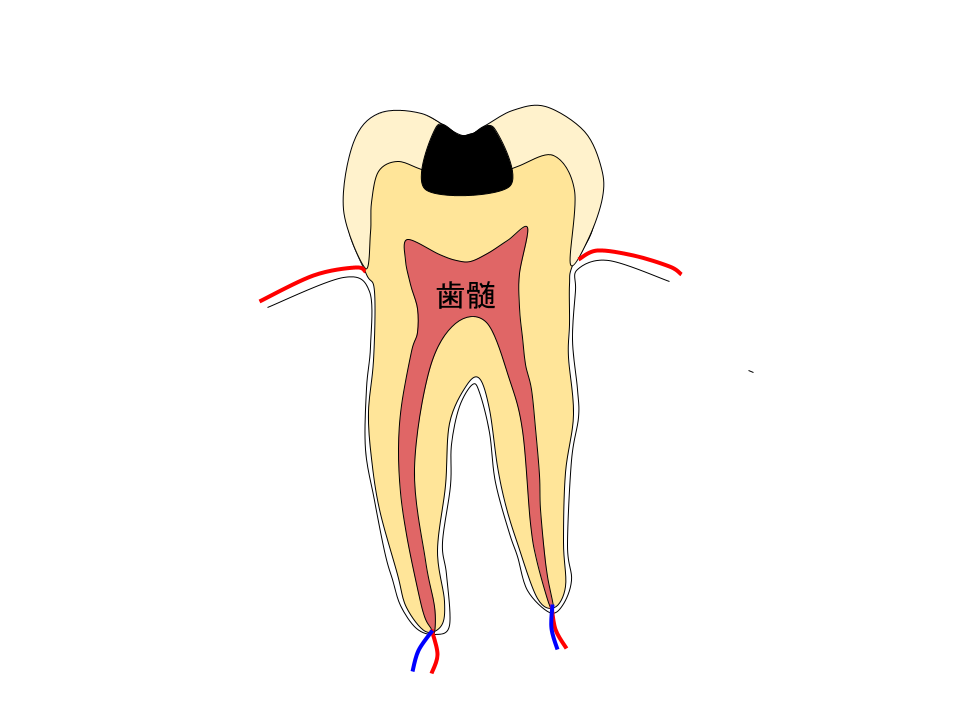 C2象牙質まで及んだ虫歯