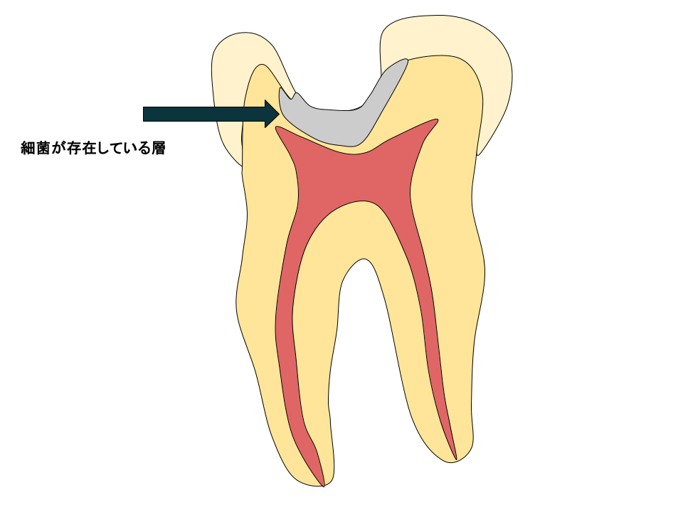 深い虫歯の図