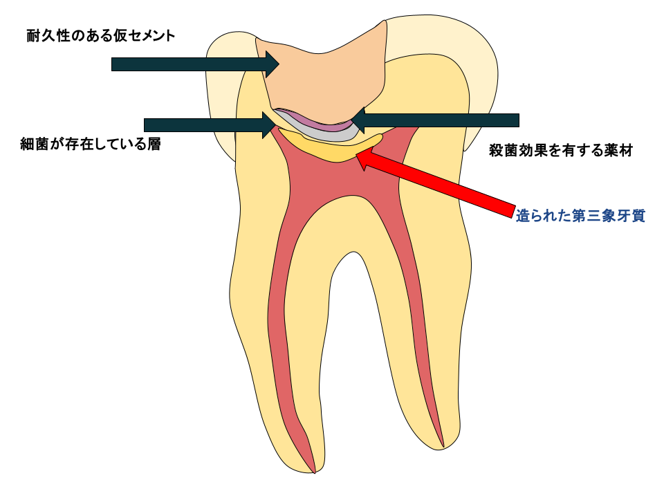 第三象牙質が作られた図