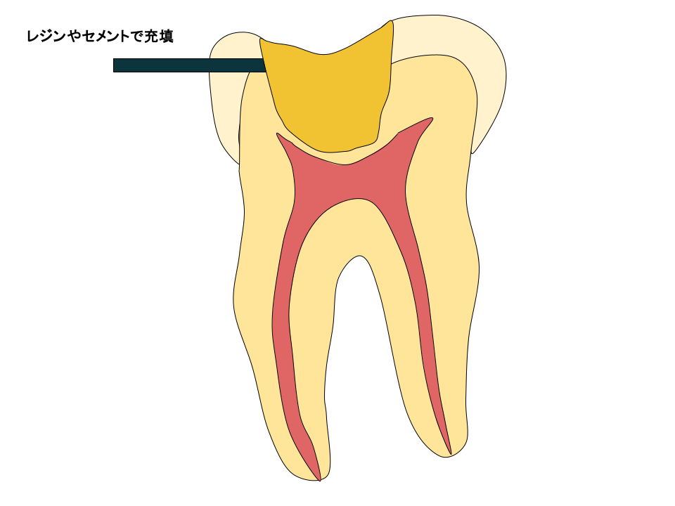 レジンやセメントで充填をしました