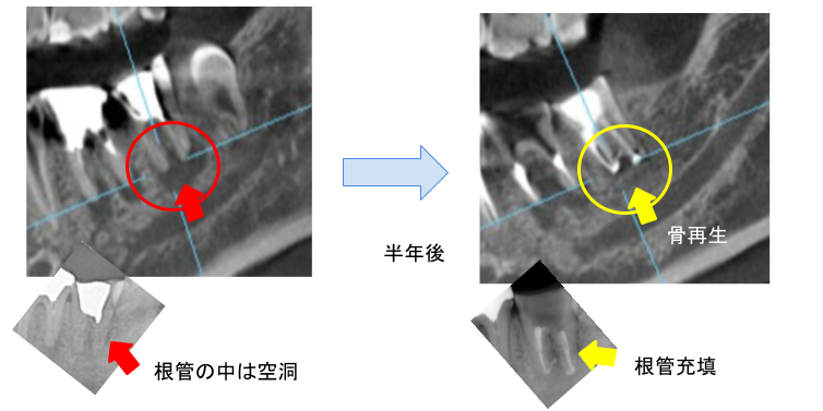 根管治療写真ケース４