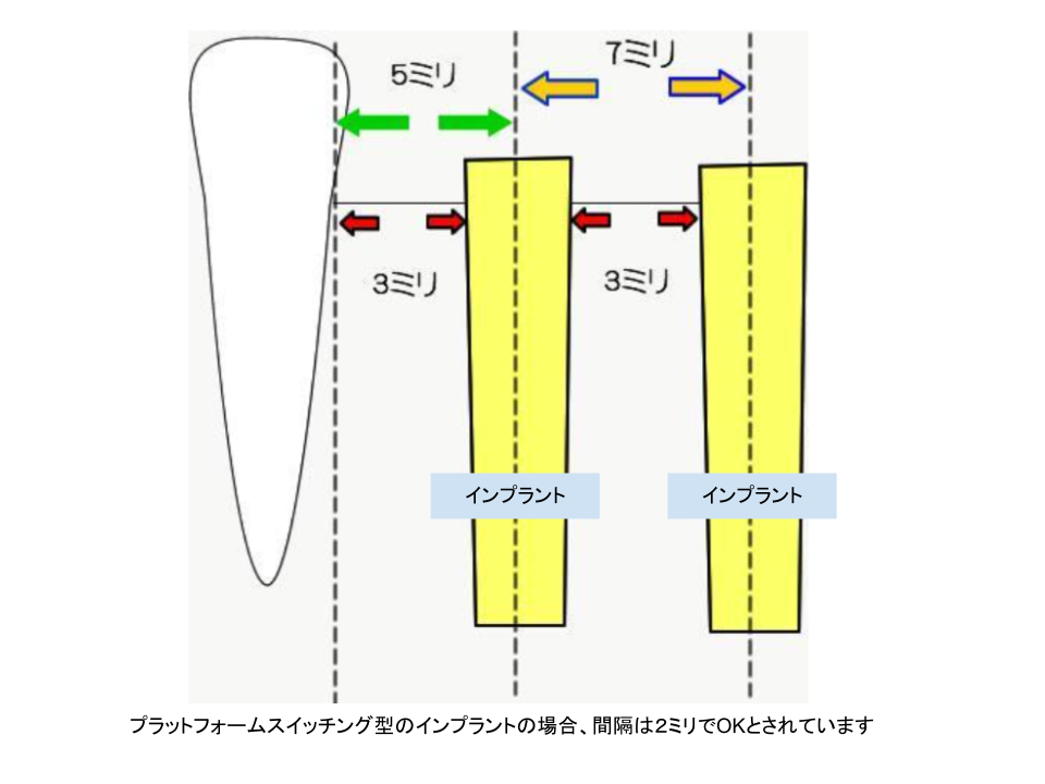 インプラントの間隔