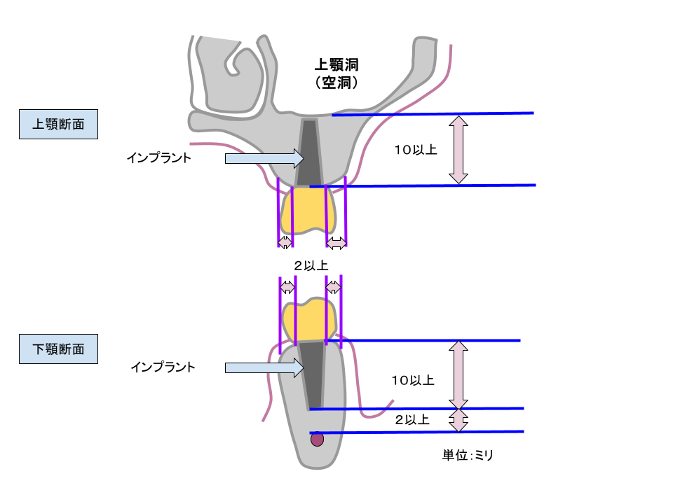 インプラントが出来るための骨の条件