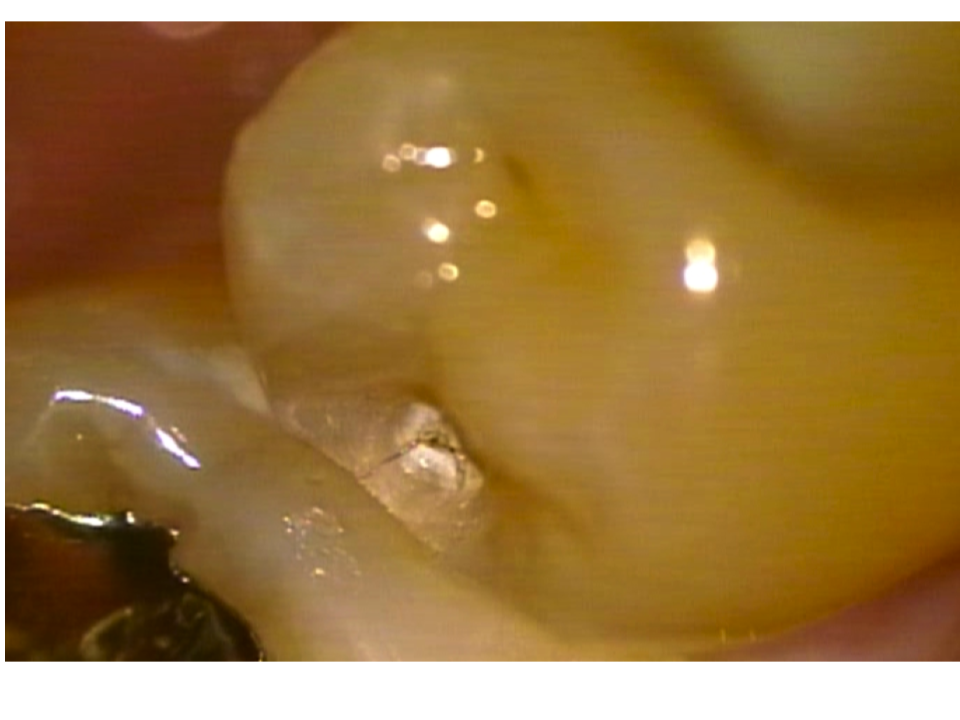 歯の隣接面のクラック