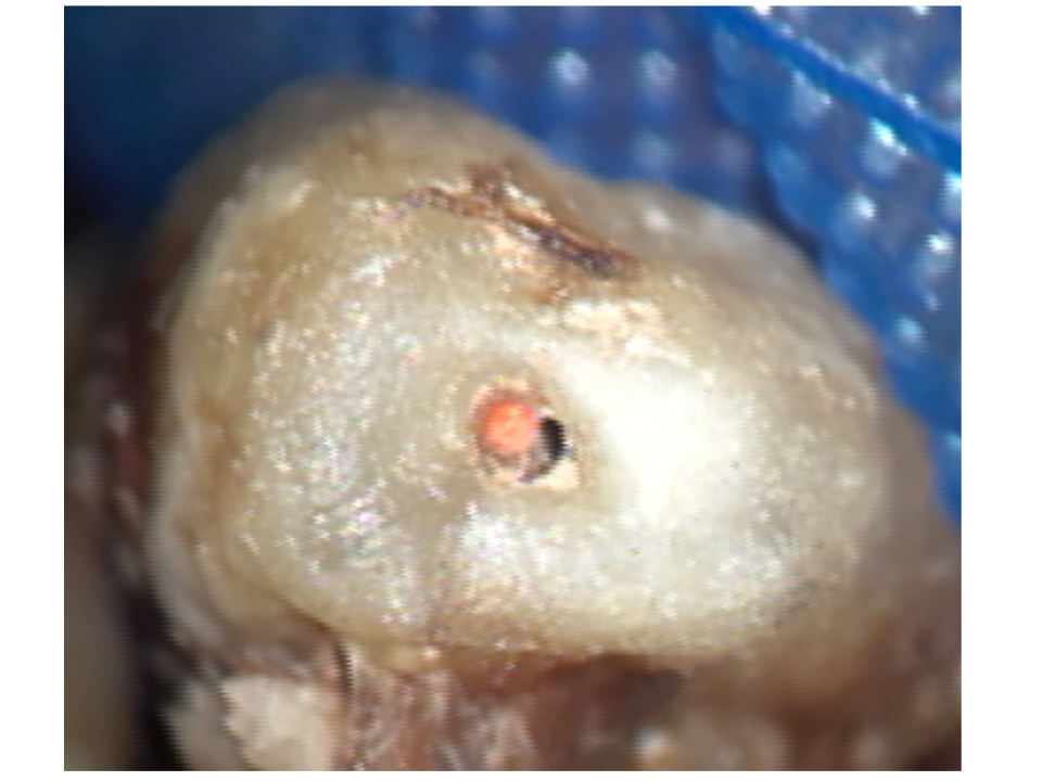 側方加圧根充の実際の根尖の状態