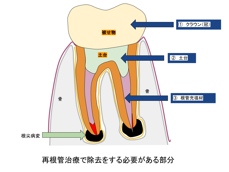 再根管治療