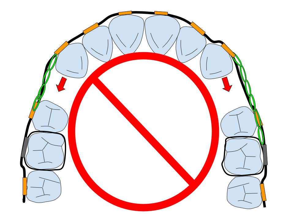 小臼歯抜歯矯正はしない方が良い