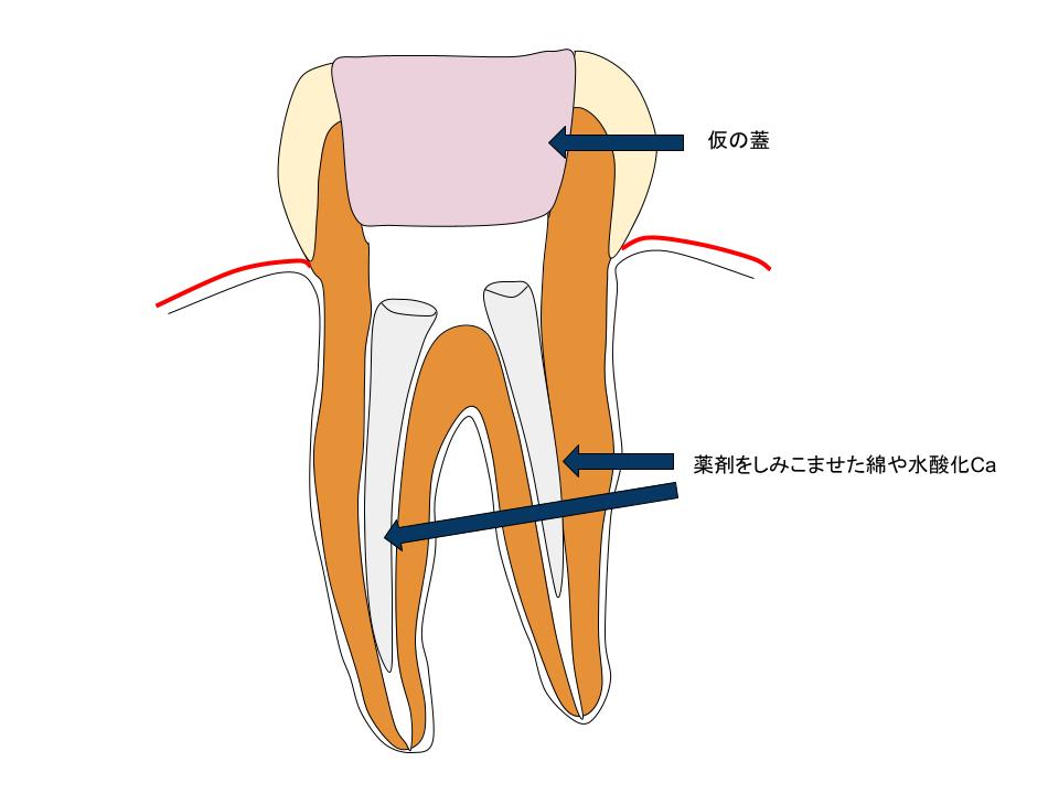 日本の根管治療１