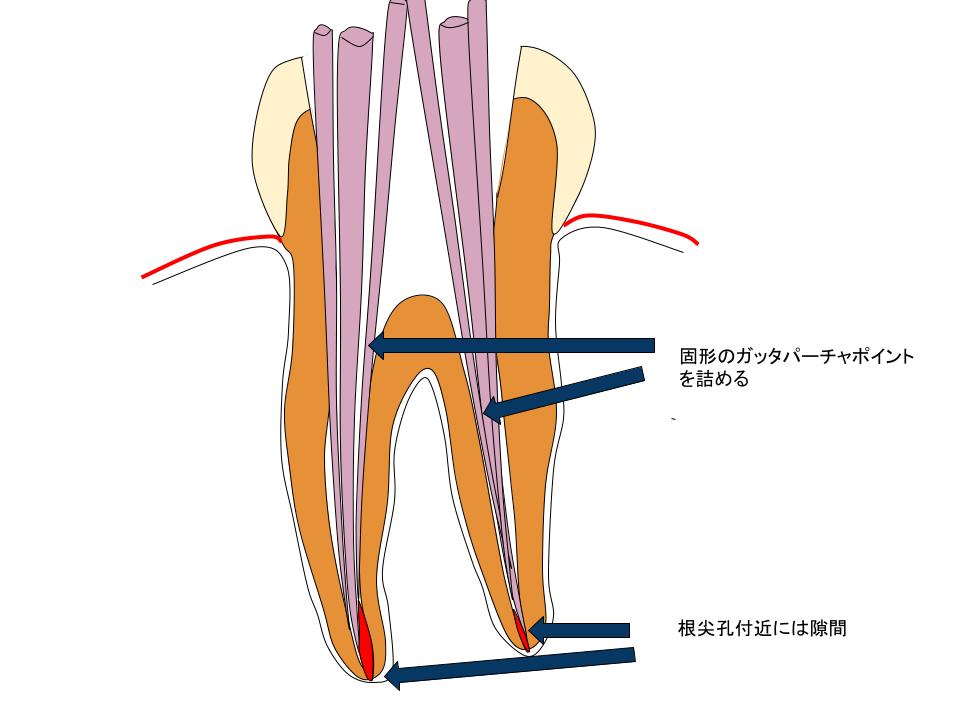 日本の根管治療２　側方加圧根充