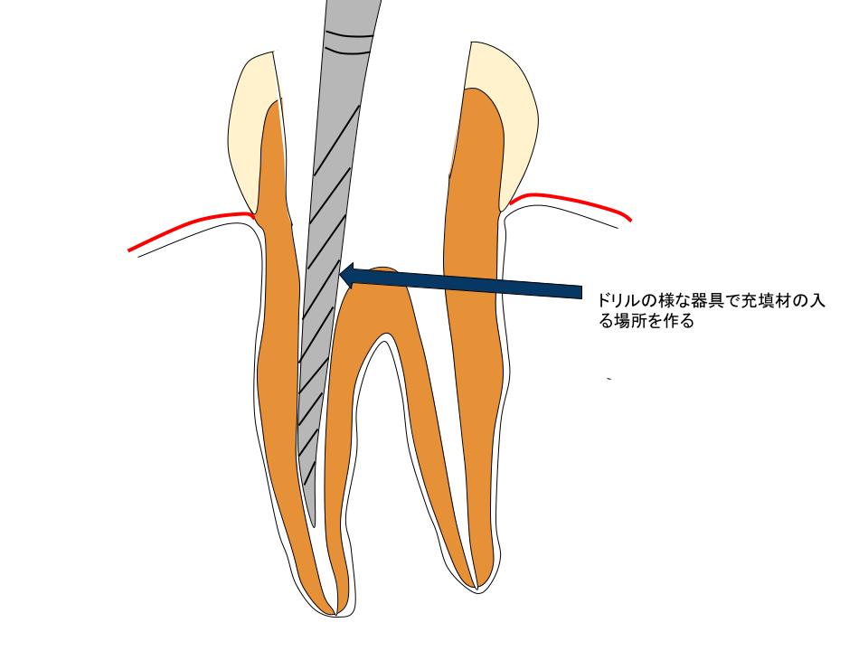 米国の根管治療１