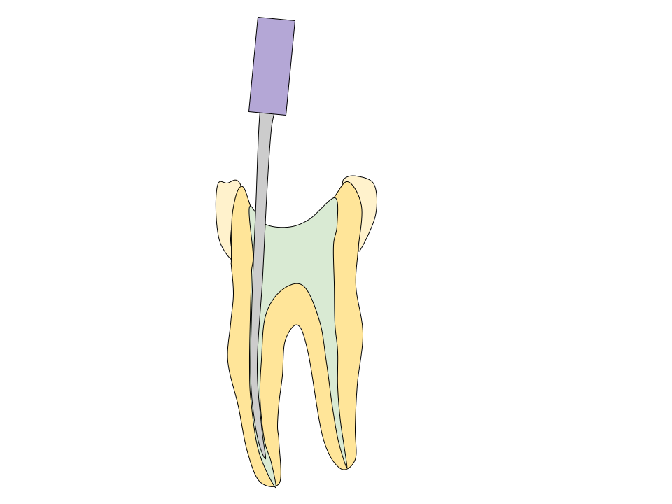 根管治療の図