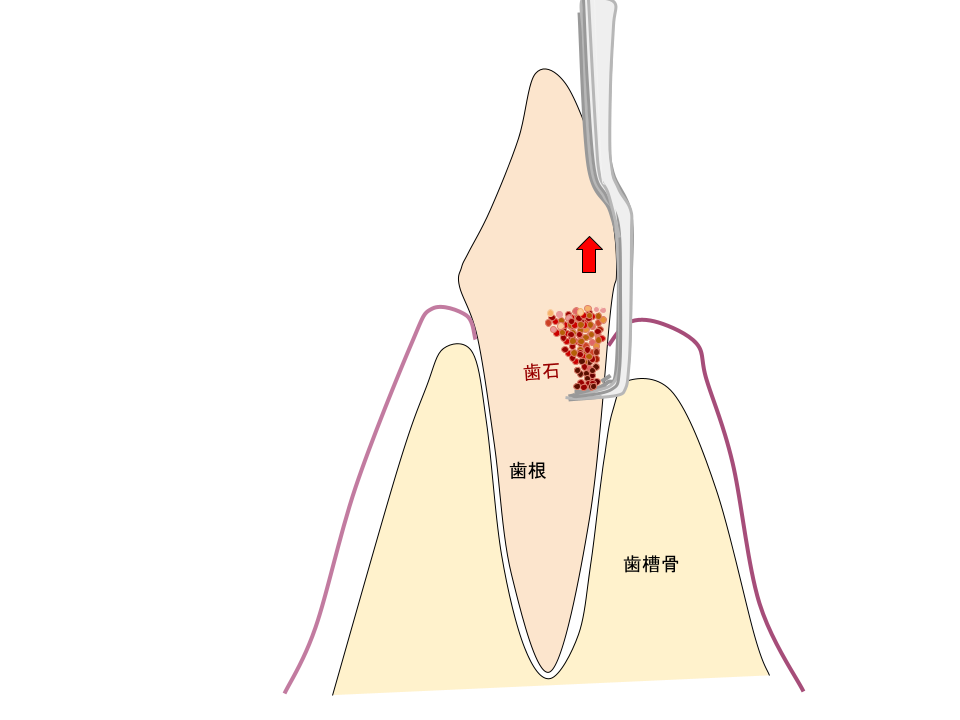 キュレットで歯石を取っている図