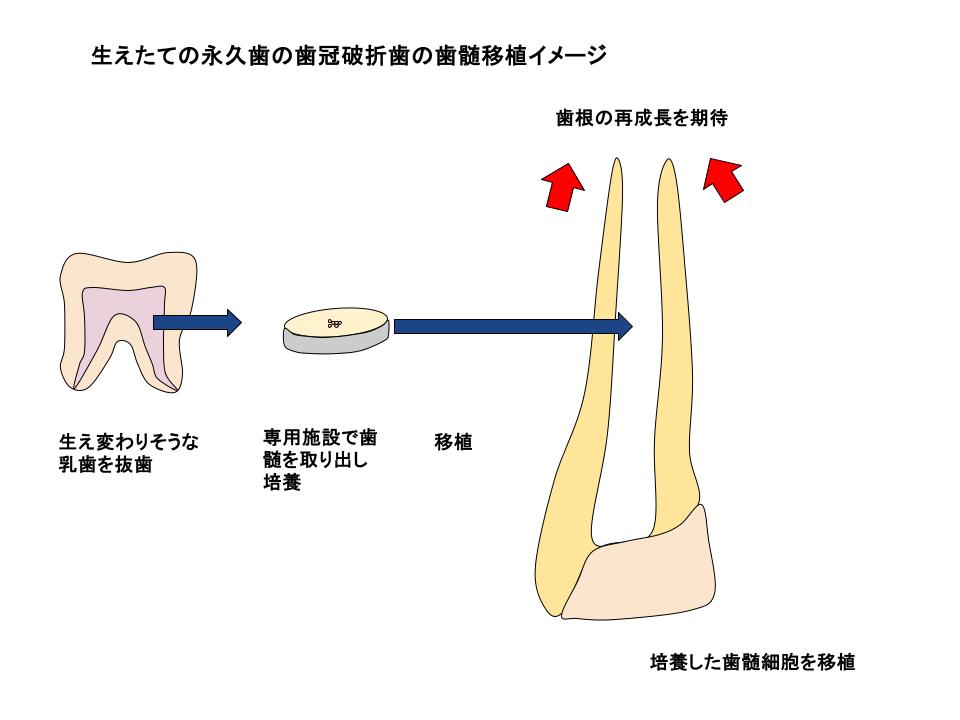 歯髄再生の模式図
