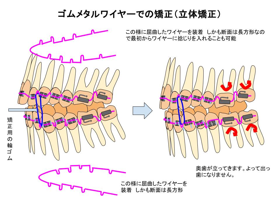 立体レベリング