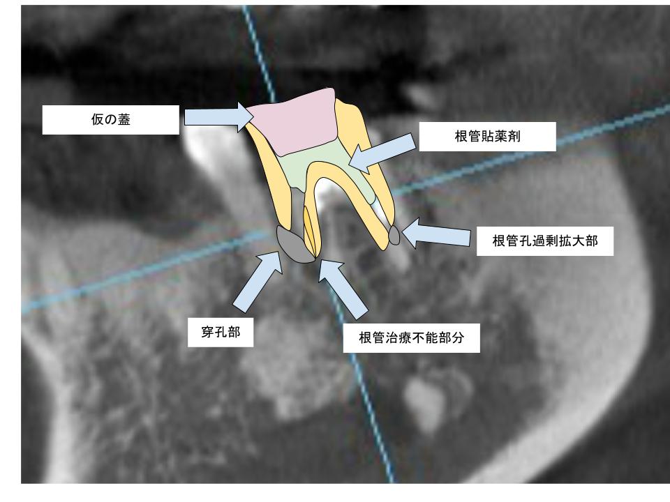 根管治療術前の図