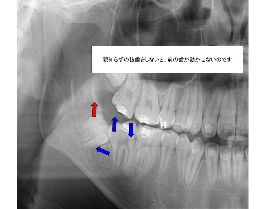 矯正治療のために親知らずの抜歯が必要です。