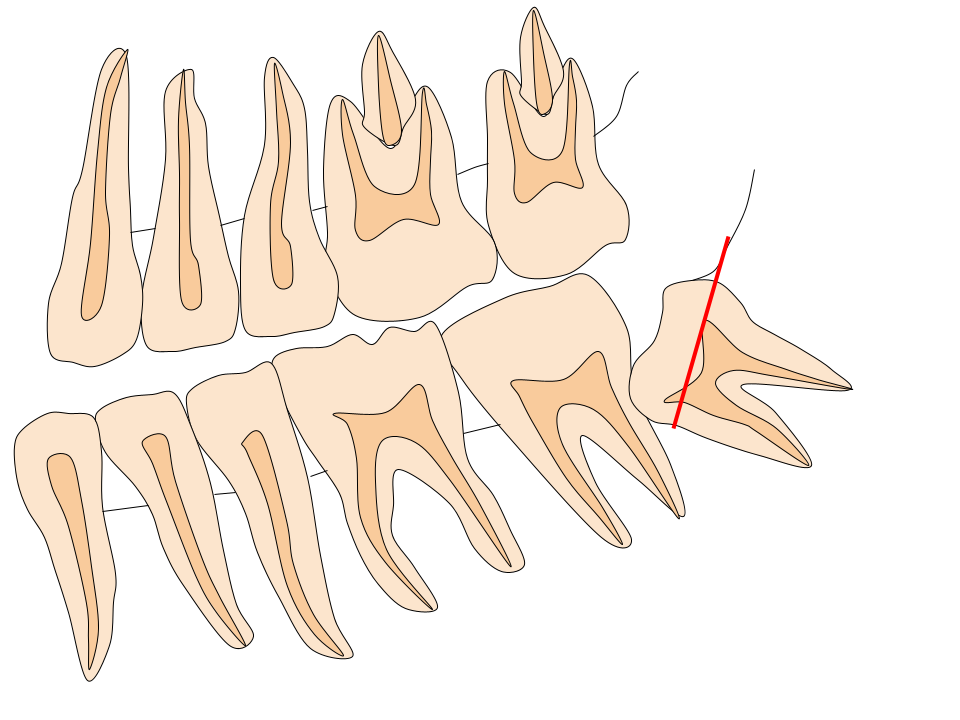 親知らずの抜歯１