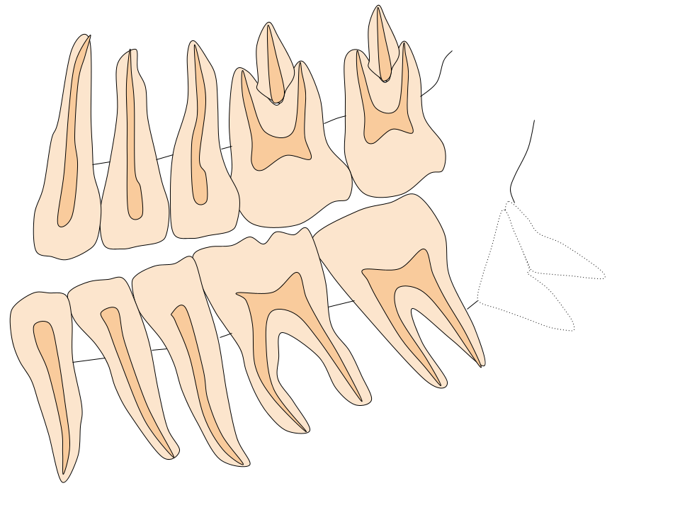 親知らずの抜歯４