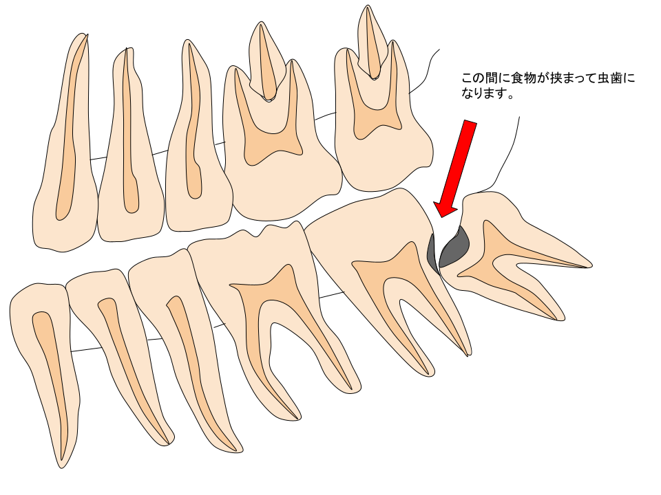 親知らずの付近の虫歯