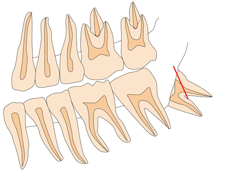 親知らずの抜歯２